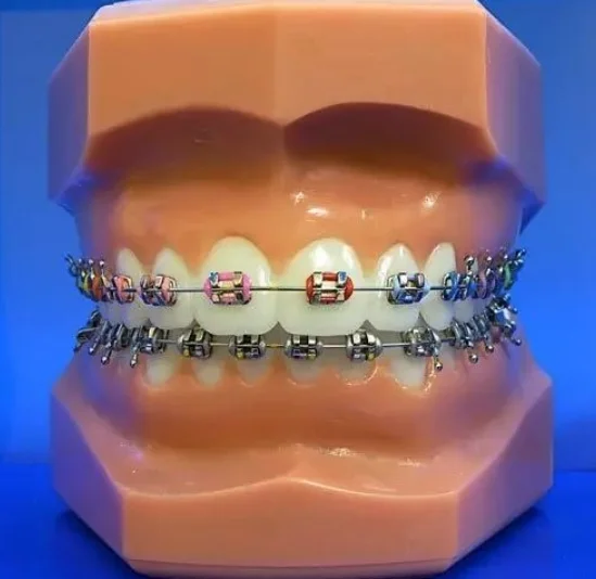 牙套的作用有什么