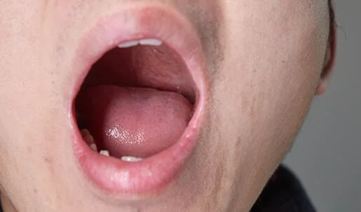 脾有病，舌头会有哪些异常