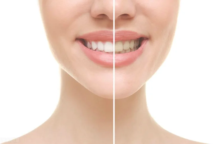 牙齿变白有效的方法有哪些，这么做你也可以拥有洁白的牙齿
