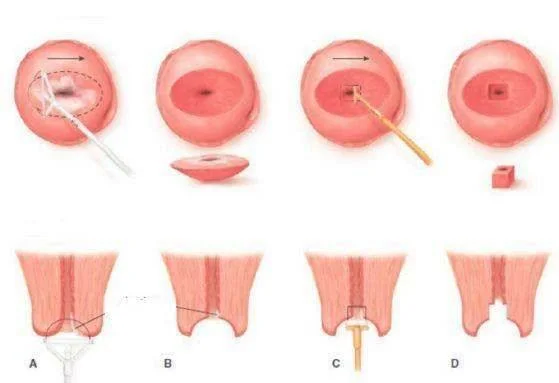 环切手术是什么(宫颈环切术后多久