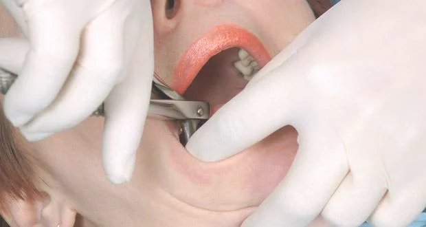 口腔科医生：拔牙前后千万别抽烟，不知道可能会后悔！