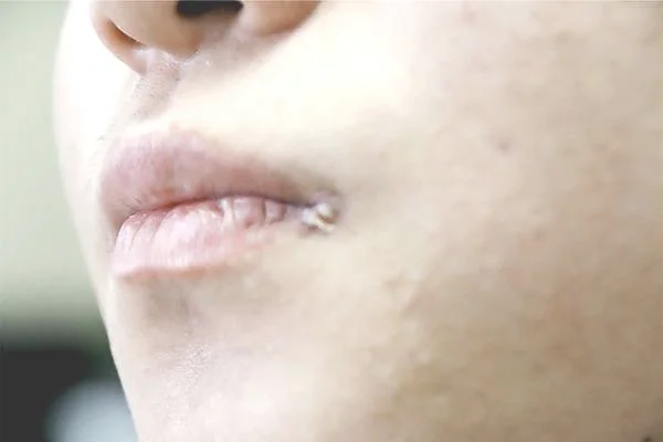 嘴上起泡是什么原因（为什么嘴角总是频繁起泡？）