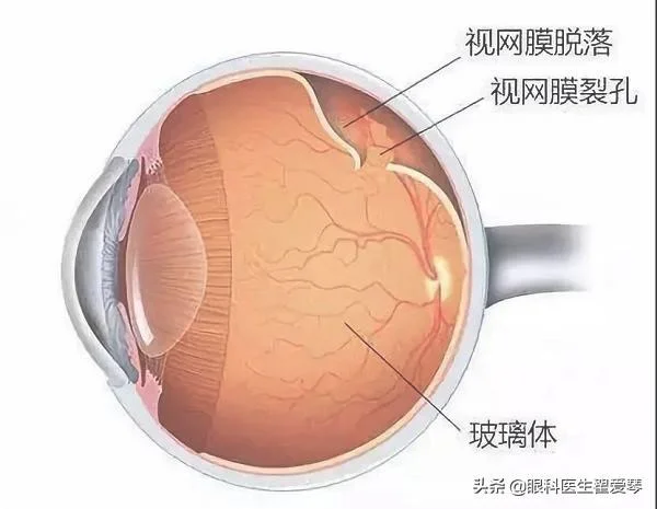 视网膜脱落手术后多久能恢复(视网膜脱落手术成功率和风险)