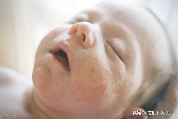 婴儿湿疹的原因？（宝宝为什么会得婴儿湿疹？）